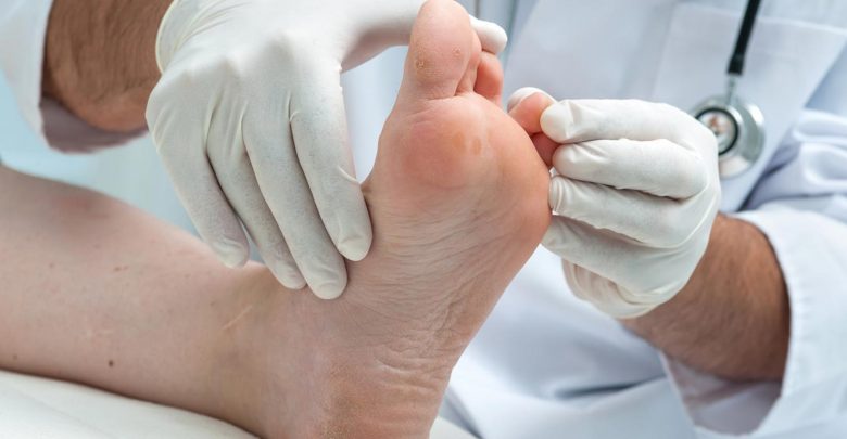 طرق علاج الكالو أو مسمار القدم واسبابه واعراضه