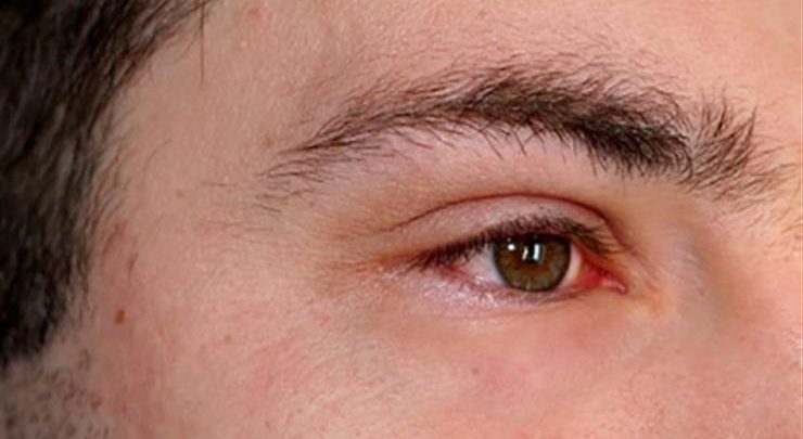 قطرة ثايلومايسين مضاد حيوي لعلاج التهابات العين Thilomicine