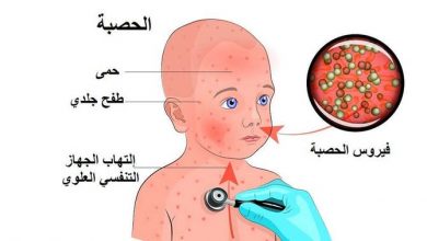 لقاح ترايفيراتين ضد الحصبة و النكاف و الحصبة الالمانية Triviraten