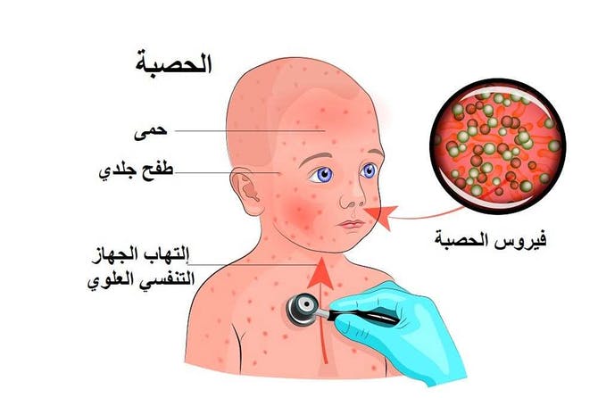 لقاح ترايفيراتين ضد الحصبة و النكاف و الحصبة الالمانية Triviraten