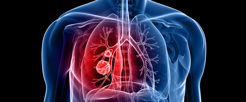سرطان الرئة أخطر انواع السرطان والأكثر شيوعاً تعرف علي انواعه واسبابه واعراضه
