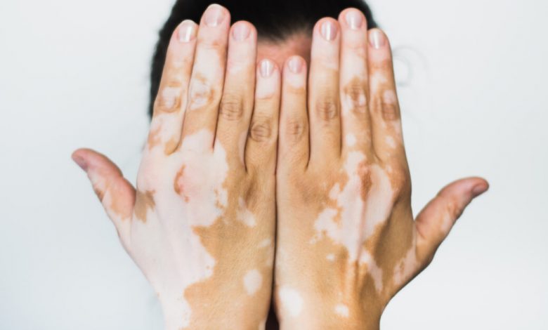 البهاق مرض جلدي يؤثر في لون الجلد تعرف علي اعراضه واسبابه وكيفية علاجه