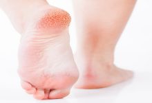 لوشن هيل اوف لعلاج تشققات وخشونة الجلد والكعبين Hill Off