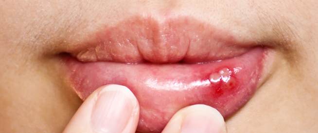 افضل الادوية المعالجة لمرض فطريات الفم وتعرف علي اسباب الاصابة به