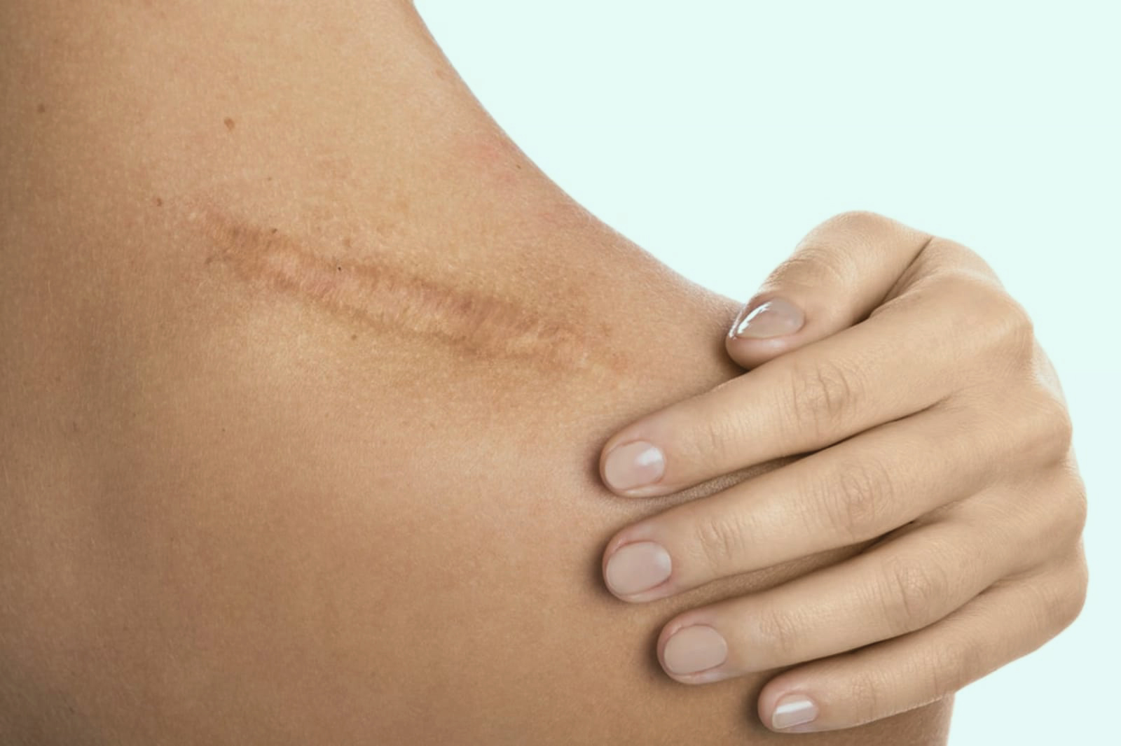 توصف أبرز وأهم المراهم والكريمات لإزالة آثار الجروح والندبات من الجلد