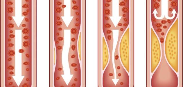 افضل انواع الادويه المعالجه لمرض تصلب الشرايين