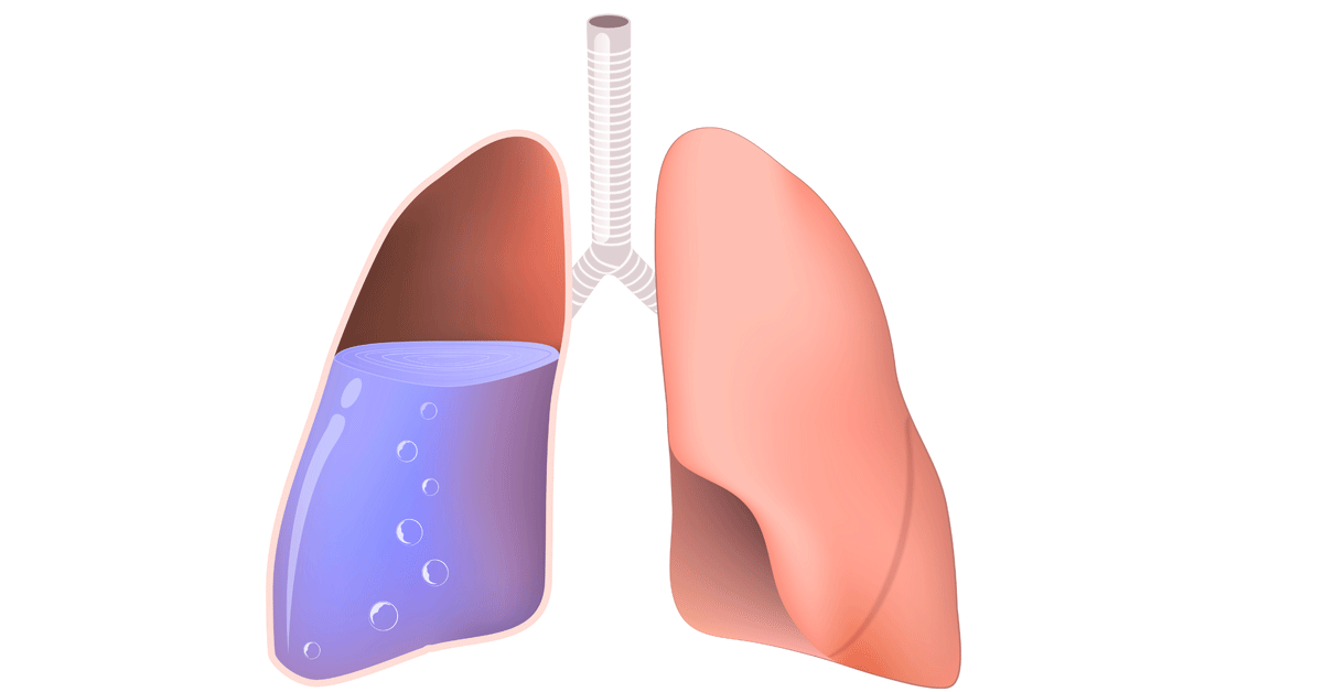 تعرف علي اعراض المياه علي الرئة وما هي الاسباب الشائعة للاصابة بها وكيفية علاجها