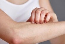 الجمرة الخبيثة تعرف علي تفاصيل الاصابة بالمرض و كيفية الوقاية و افضل الادوية المعالجة