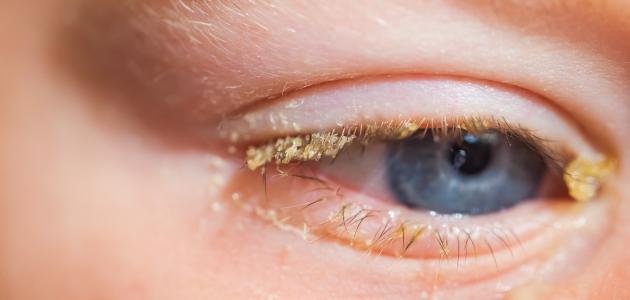 اسباب ظهور عماص العين وما افضل طرق علاجه وأهم النصائح لوقاية العين