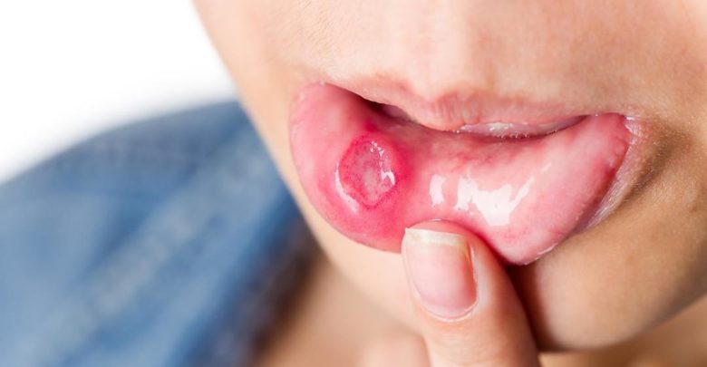 أفضل الادوية الفعالة لعلاج فطريات الفم لدي الاطفال وكيفية الوقاية منها