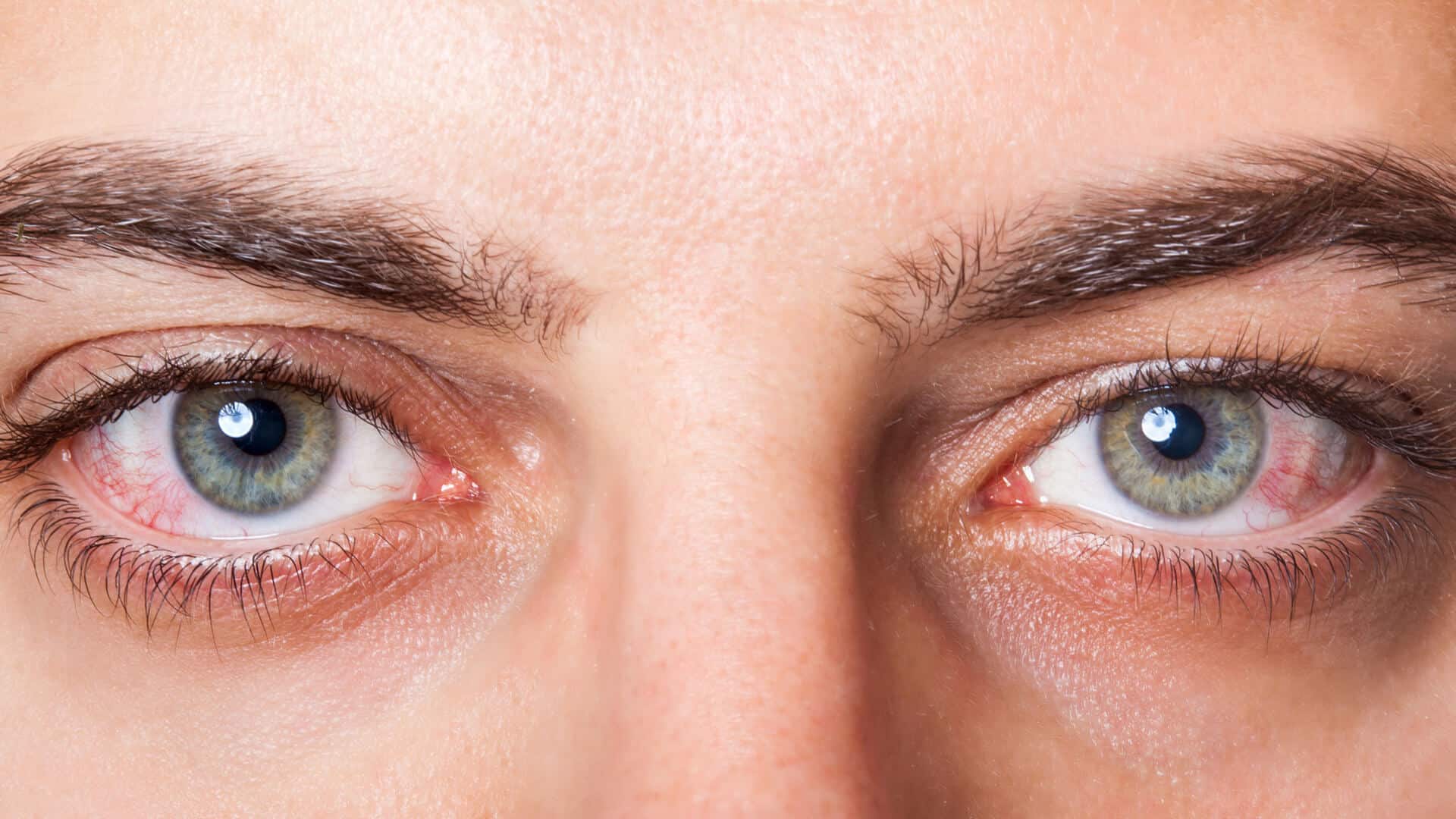 افضل قطرة لعلاج جفاف العين والطرق الطبيعية لتقليل الآلام في العين