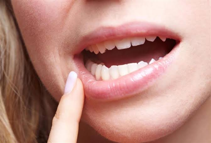 فطريات الفم و افضل الوصفات المنزليه لتقليل الالم
