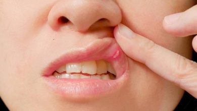 علاج قرح الفم و افضل الطرق الفعاله للتخلص منها