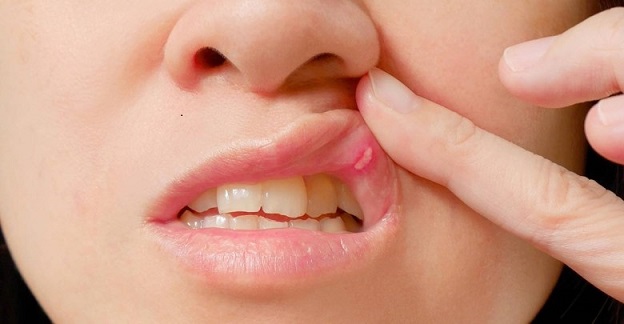 علاج قرح الفم و افضل الطرق الفعاله للتخلص منها