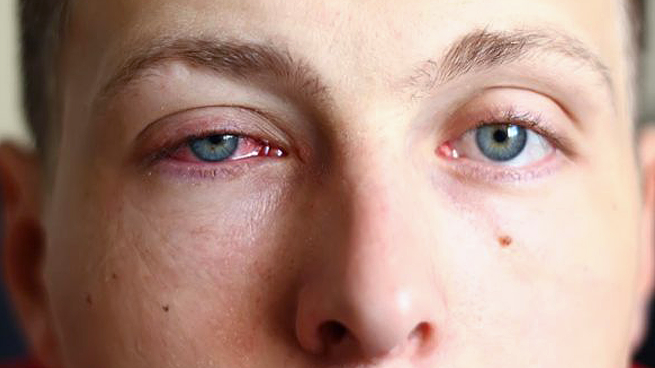 افضل الادوية لعلاج التهابات العين وكيفية الوقاية من الاصابة بها