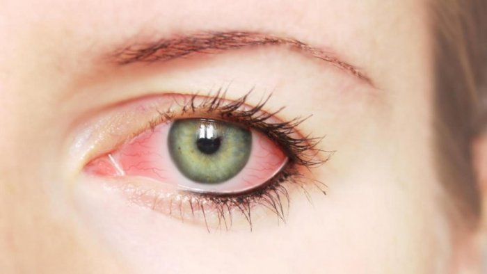 انواع التهاب العين البكتيرى وافضل الطرق العلاجيه