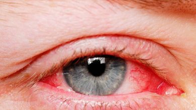 علاج احمرار العين الشديد وطرق الحفاظ علي صحة العينين