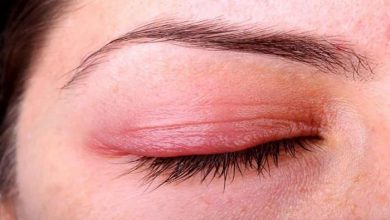 علاج التهاب جفن العين والنصائح الهامه لتنظيف الجفون