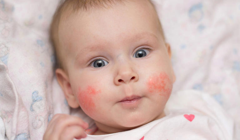 اسباب حساسية الجلد عند الاطفال وطرق علاجها ونصائح لتجنب الاصابة بها