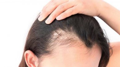 اسباب مرض الثعلبه و الطرق الطبيعيه لتحفيز نمو الشعر