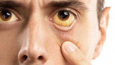 اصفرار العين قد يشير الي حالة مرضية تعرف علي اسبابه وطرق علاجه