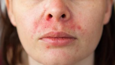 علاج حساسيه الوجه و النصائح المنزليه لتخفيف الاعراض