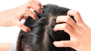 اسباب القشرة الدهنية في الشعر وطرق علاجها بافضل المستحضرات الطبية