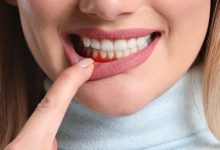 طرق طبيعية للتخلص من التهاب اللثة في الفم والعناية بصحة الفم والاسنان