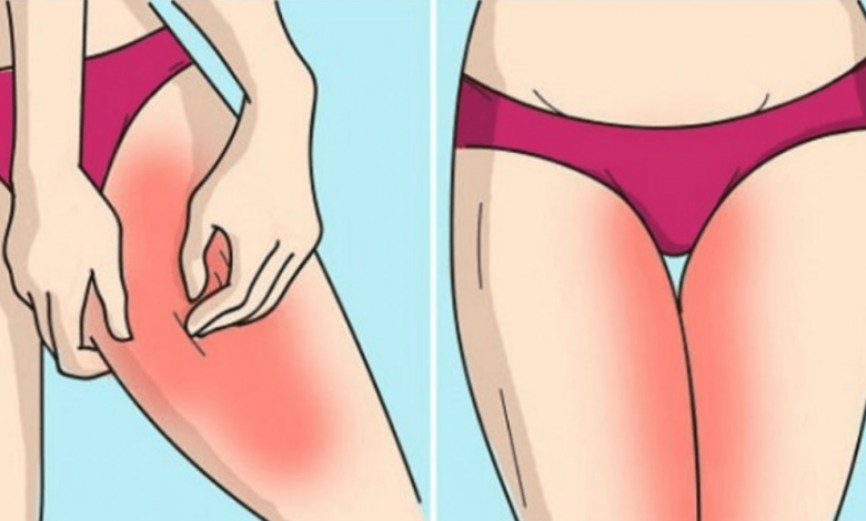 وصفات طبيعيه لعلاج تسلخات الفخذين و افضل طرق الوقايه منها