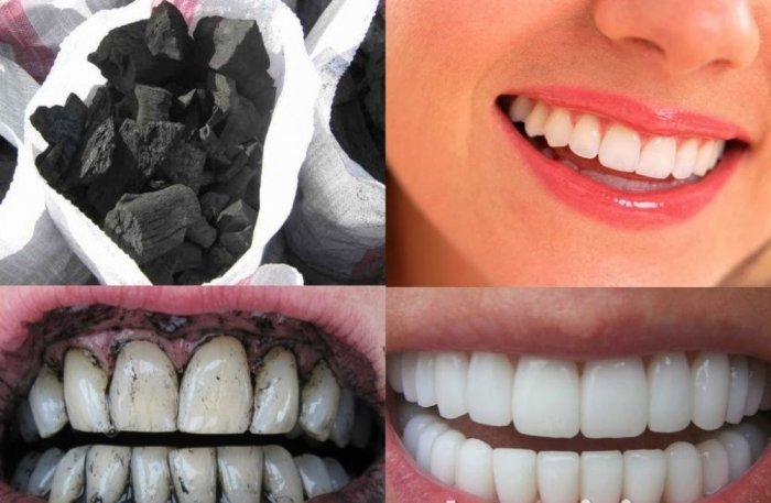فوائد الفحم في تبييض الاسنان والطريقة الصحيحة لاستخدام الفحم للاسنان